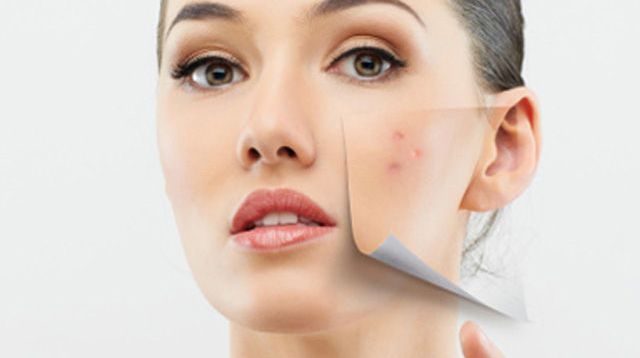 comment-venir-a-bout-de-son-acne-tardive-13_1959742