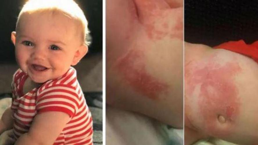 Son Bebe A Subi De Violentes Brulures Chimiques Apres Avoir Porte Un Lange Tesco Sa Peau Commencait A Se Decoller E Zapping Son Bebe A Subi De Violentes Brulures Chimiques Apres Avoir Porte Un Lange Tesco Sa Peau Commencait A Se Decoller E Zapping